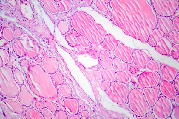 Tiroidite Fibrosa Microscopio Leggero Foto Microscopio Una Malattia Caratterizzata Infiammazione — Foto Stock