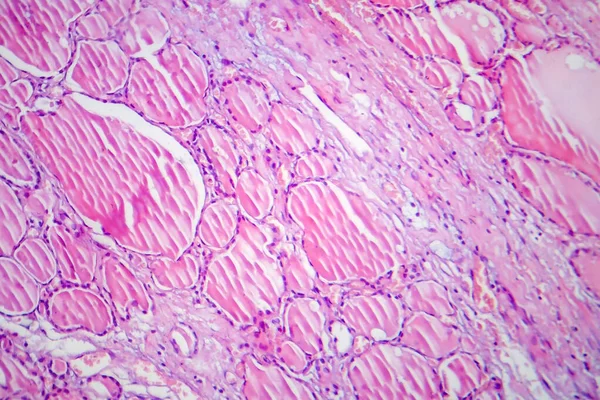 纤维性甲状腺炎 显微镜下照片 甲状腺肿一种以甲状腺慢性炎症和纤维化为特征的疾病 — 图库照片