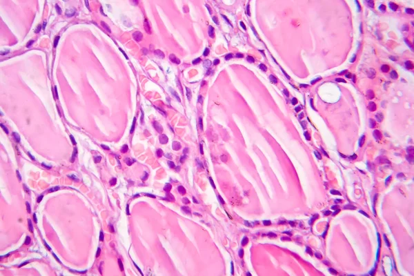 Tiroiditis Serat Mikrograf Cahaya Foto Bawah Mikroskop Penyakit Yang Ditandai — Stok Foto