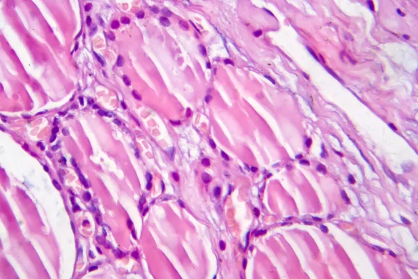 Tiroiditis Fibrosa Micrografía Ligera Foto Bajo Microscopio Enfermedad Caracterizada Por — Foto de Stock