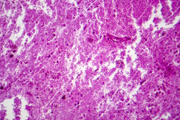 Meningite Purulenta Micrografia Luz Foto Sob Microscópio — Fotografia de Stock