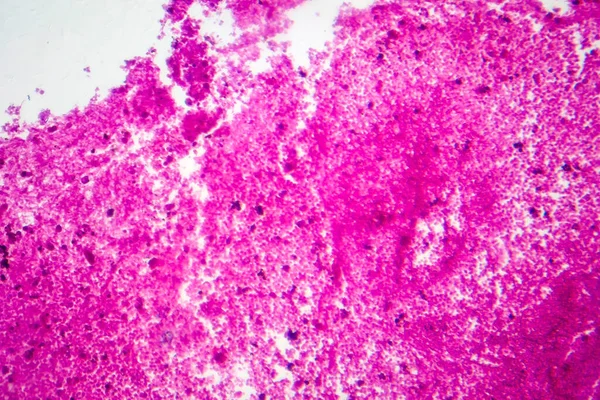 수막염 현미경으로 현미경 — 스톡 사진