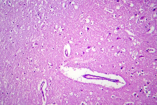 Histopatología Encefalitis Japonesa Micrografía Ligera Foto Bajo Microscopio — Foto de Stock