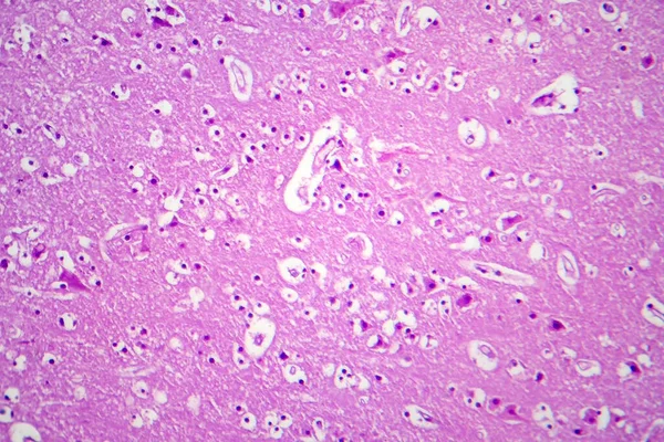 顕微鏡下での日本脳炎の病理学 光マイクログラフ — ストック写真