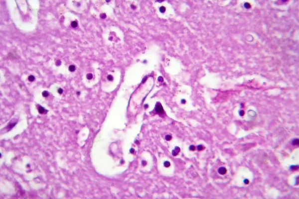 Histopatologia Encefalite Japonesa Micrografia Luz Foto Sob Microscópio — Fotografia de Stock