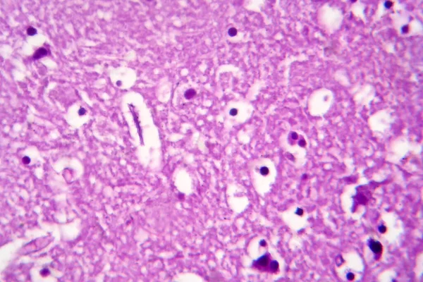 Histopathology of Japanese encephalitis, light micrograph, photo under microscope