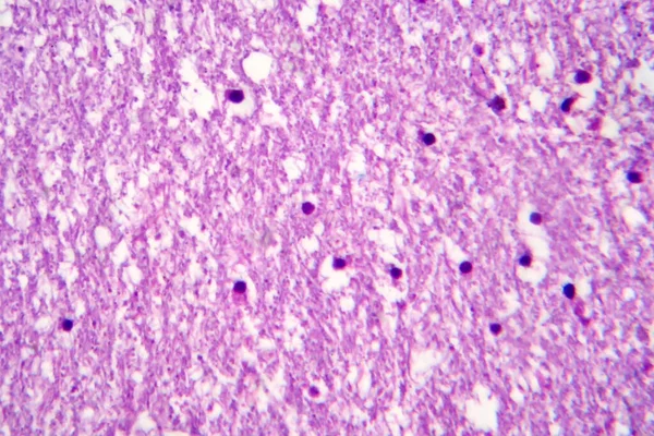 Histopatología Encefalitis Japonesa Micrografía Ligera Foto Bajo Microscopio —  Fotos de Stock