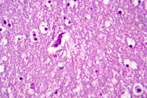Histopatología Encefalitis Japonesa Micrografía Ligera Foto Bajo Microscopio —  Fotos de Stock