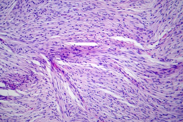 Meningioma Tumor Crecimiento Lento Que Forma Partir Las Meninges Micrografía —  Fotos de Stock