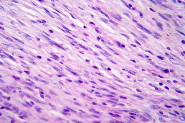 Meningioma Tumor Crescimento Lento Que Forma Partir Das Meninges Micrografia — Fotografia de Stock