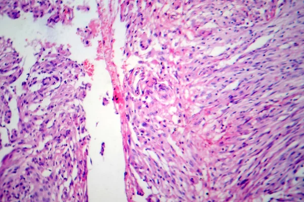 Meningioma Tumor Crescimento Lento Que Forma Partir Das Meninges Micrografia — Fotografia de Stock