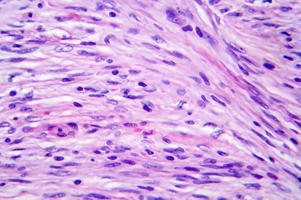 Meningioma Tumor Crecimiento Lento Que Forma Partir Las Meninges Micrografía — Foto de Stock