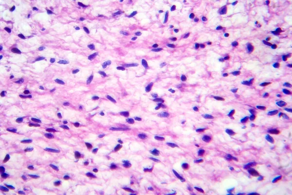 소모증 현미경 현미경 아래의 계내에 형성되어 유전적 질환들의 — 스톡 사진