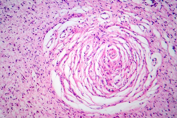 神経線維腫症 ライトマイクログラフ 顕微鏡下の写真 神経系に腫瘍が形成される遺伝性疾患のグループ — ストック写真