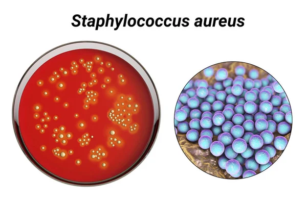 Bacteria Staphylococcus Aureus Colonies Sheep Blood Agar Medium Closeup View — Stock Photo, Image