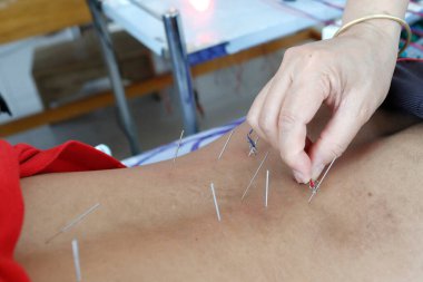 Vietnam geleneksel tıp kliniği. Akupunktur. Cu Chi. Vietnam. 