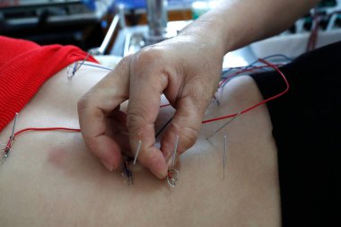 Vietnam geleneksel tıp kliniği. Akupunktur. Cu Chi. Vietnam. 