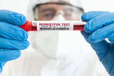 Doctor equipped with protective equipment looks at a blood sample with a positive result for monkeypox