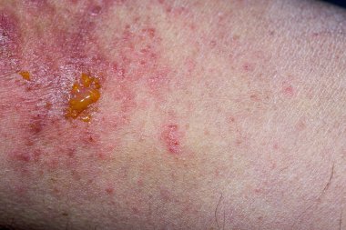 Yetişkin bir erkeğin sol dirsek çukurunda atopik dermatit semptomlarının aşırı yakın plan fotoğrafı..