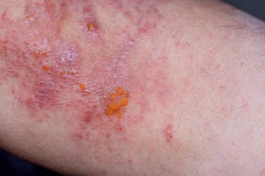 Extreme close-up photography of the atopic dermatitis symptoms on  the left elbow pit of an adult male in a very advance stage.
