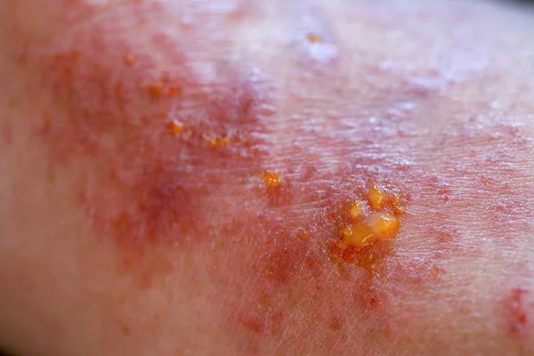 Yetişkin bir erkeğin sol dirsek çukurunda atopik dermatit semptomlarının aşırı yakın plan fotoğrafı..