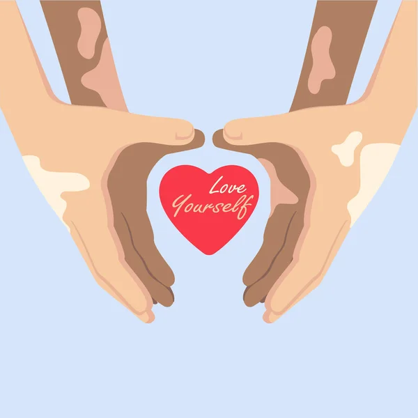 Hands Vitiligo Depigmantation Forming Heart Shape Symbol — Διανυσματικό Αρχείο