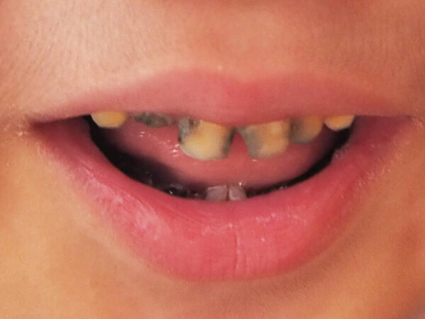 Close-up, unhealthy baby teeth, Asian.