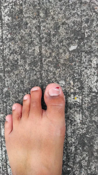Injured Bleeding Big Toe Asphalt Pangandaran Indonesia — Stock Photo, Image
