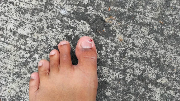 Injured Bleeding Big Toe Asphalt Pangandaran Indonesia — Stock Photo, Image