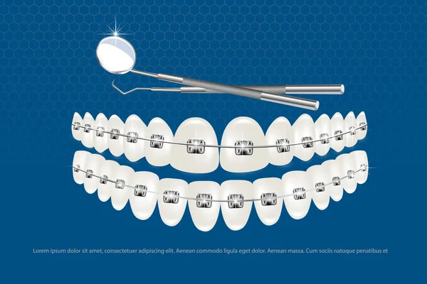 Illustrazione vettoriale 3d, denti realistici con bretelle mascella superiore e inferiore. Allineamento del morso dei denti, dentizione con bretelle, apparecchio dentale. — Vettoriale Stock