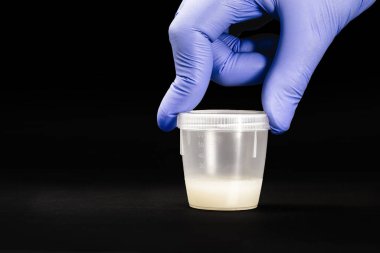 Sperm kültürü için sperm içeren örnek kabı sperm kalitesini ve patojenik maddelerin varlığını saptamak amacıyla incelenecek.