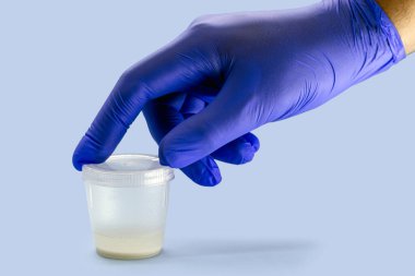 Elinizde azot eldiveni, sperm örneği toplama kabı, sperm bağışı konsepti var.