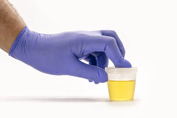 Collection Bottle Urine Being Handled Blue Gloved Hand Eas Urine — Stock Photo, Image