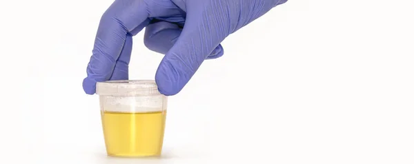 Bouteille Collecte Urine Tenue Par Main Bleue Gantée Test Urine — Photo