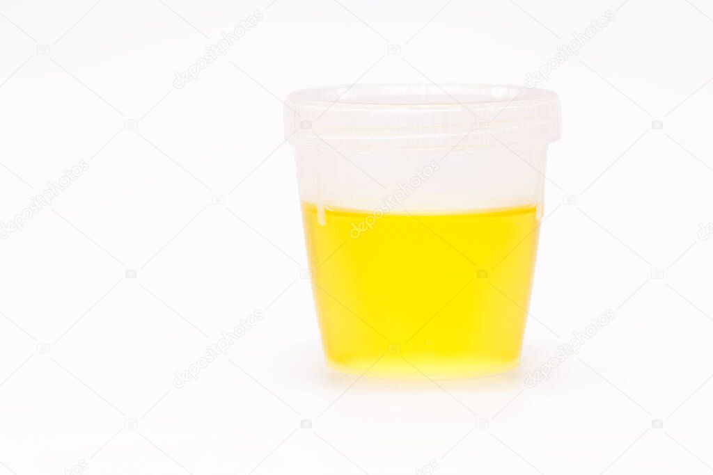 collection bottle with urine, urinalysis EAS Abnormal Sediment Elements, serves to analyze the pH of urine such as: Nitrites, Proteins, Urobilinogen, Urine Density, Ketones, Leukocytes, Glucose