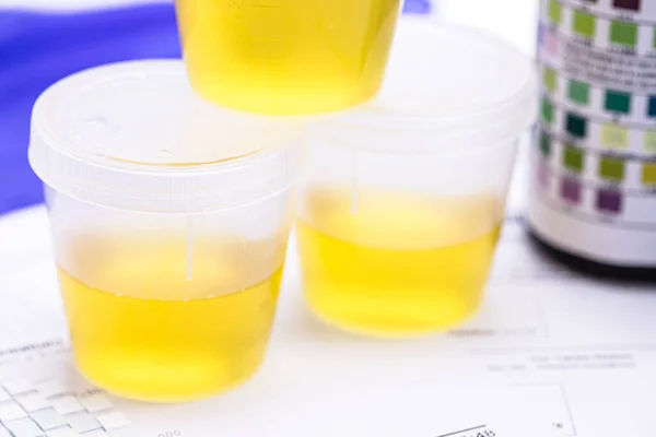 Urine Flacon Laboratorium Toxicologie Routine Onderzoek Flacons Met Urine Voor — Stockfoto