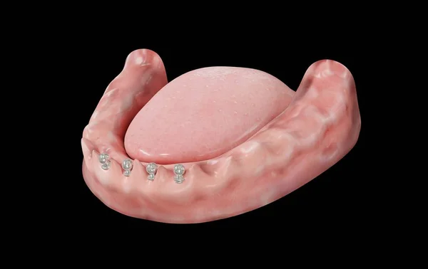 4 orthodontic screws on gum 3d rendering on black background side view
