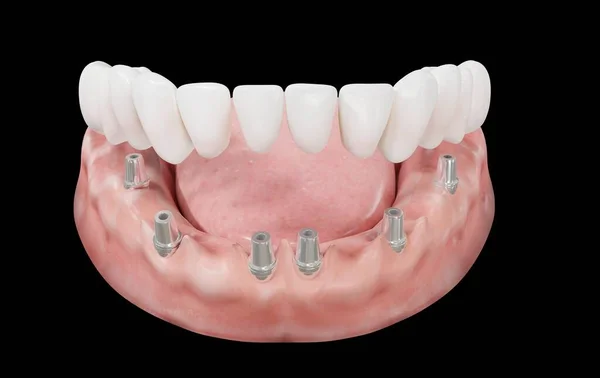 representation of mandibular prostheses 3d rendering on black background