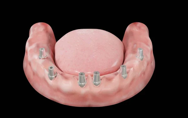 6 orthodontic screws on gum 3d rendering on black background