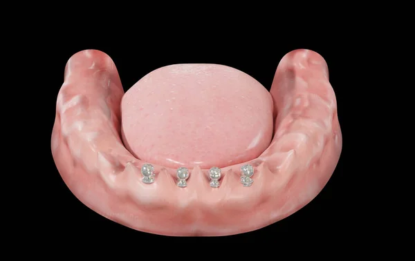 4 orthodontic screws on gum 3d rendering on black background front view