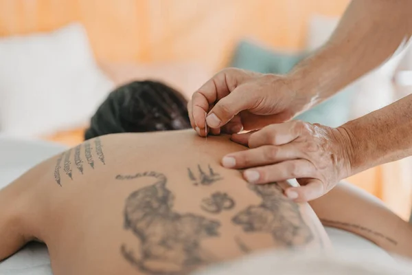 Detail Acupuncturists Hands Acupuncture Needle Stuck Womans Tattooed Skin Health — Stockfoto