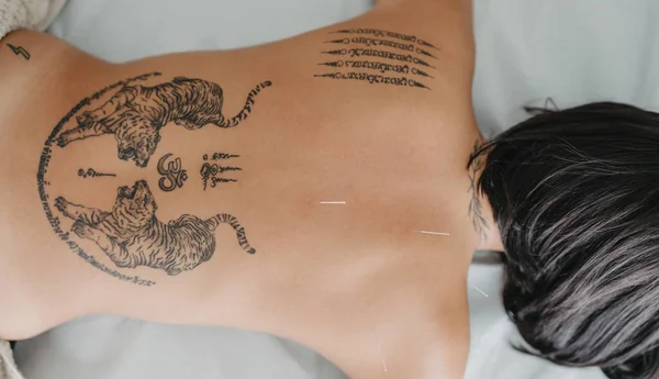 zenithal view of the back of a tattooed woman with acupuncture needles stuck in her back. Health