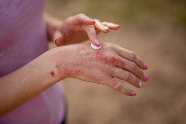 Ellerinde egzama var. Merhemi süren kadın, egzama, sedef ve diğer deri hastalıklarının tedavisinde kremler. Cilt problemi kavramı.