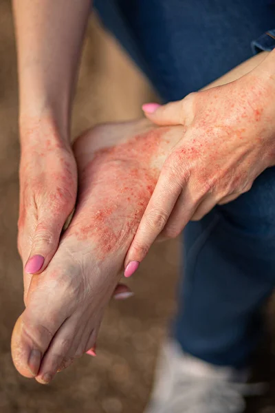 eczema dermatitis on hands and feet. red spots on the skin. dry skin.