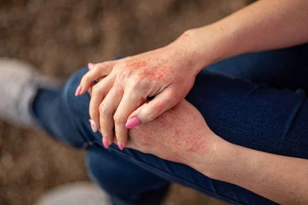 Managing Chronic Inflammation with Psoriasis: Expert Guide | Stock Photo