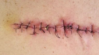 Tıbbi dikişler, ameliyat üstüne dikiş, insan vücuduna dikişler. Tıbbi cerrahi bakım. Yakın plan..