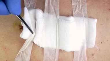 Tıbbi dikişler, ameliyat üstüne dikiş, insan vücuduna dikişler betadin sürülmüş. Tıbbi cerrahi bakım. Yakın plan..