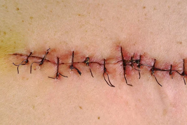 Suturas Médicas Pontos Após Cirurgia Suturas Cirúrgicas Costuradas Corpo Humano Imagem De Stock