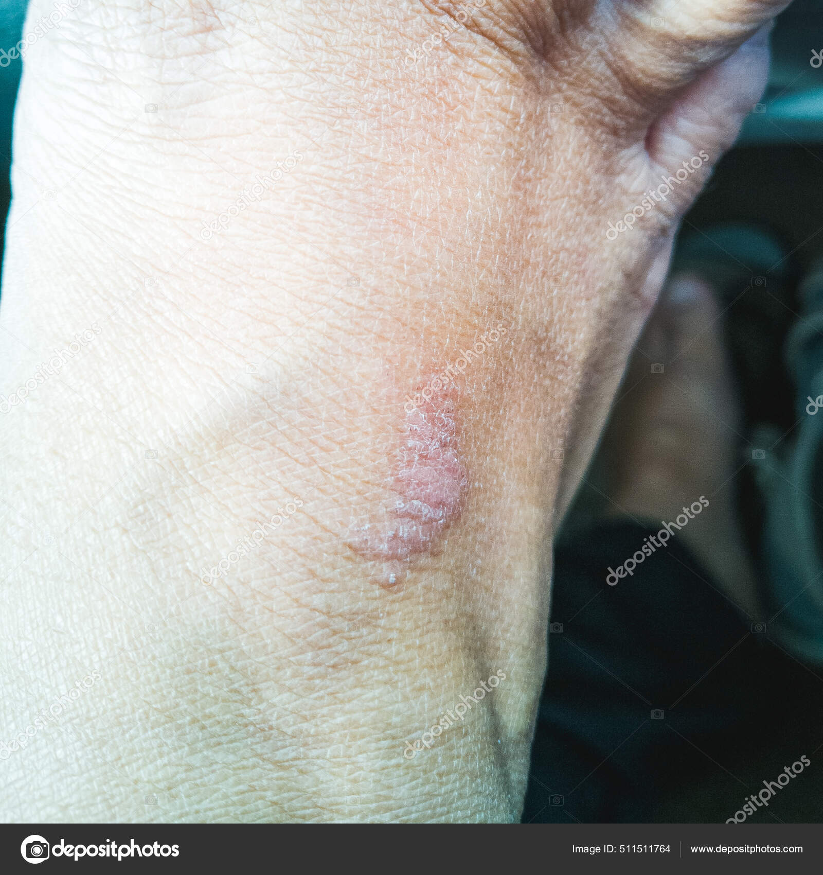 Skin Rash Due Marine Coral Poisoning Healing Process Applying Salt