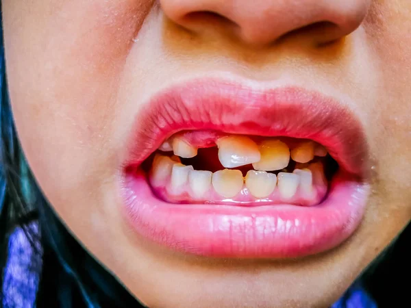 Азиатский Ребенок Улыбается Показать Переполненный Зуб — стоковое фото